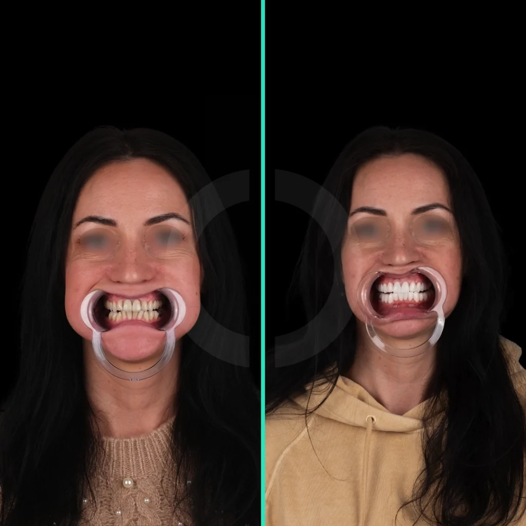 dental-aesthetics-before-after-2