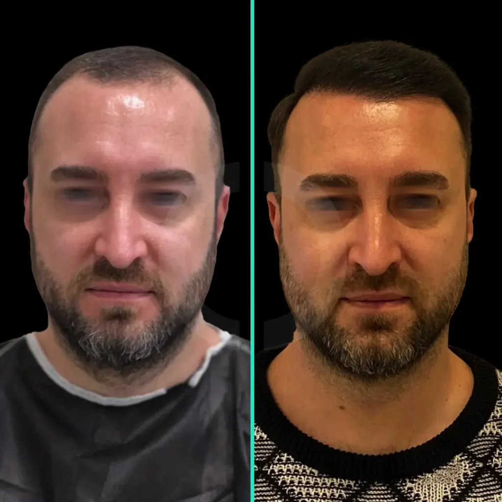 hair-transplant-before-after-1