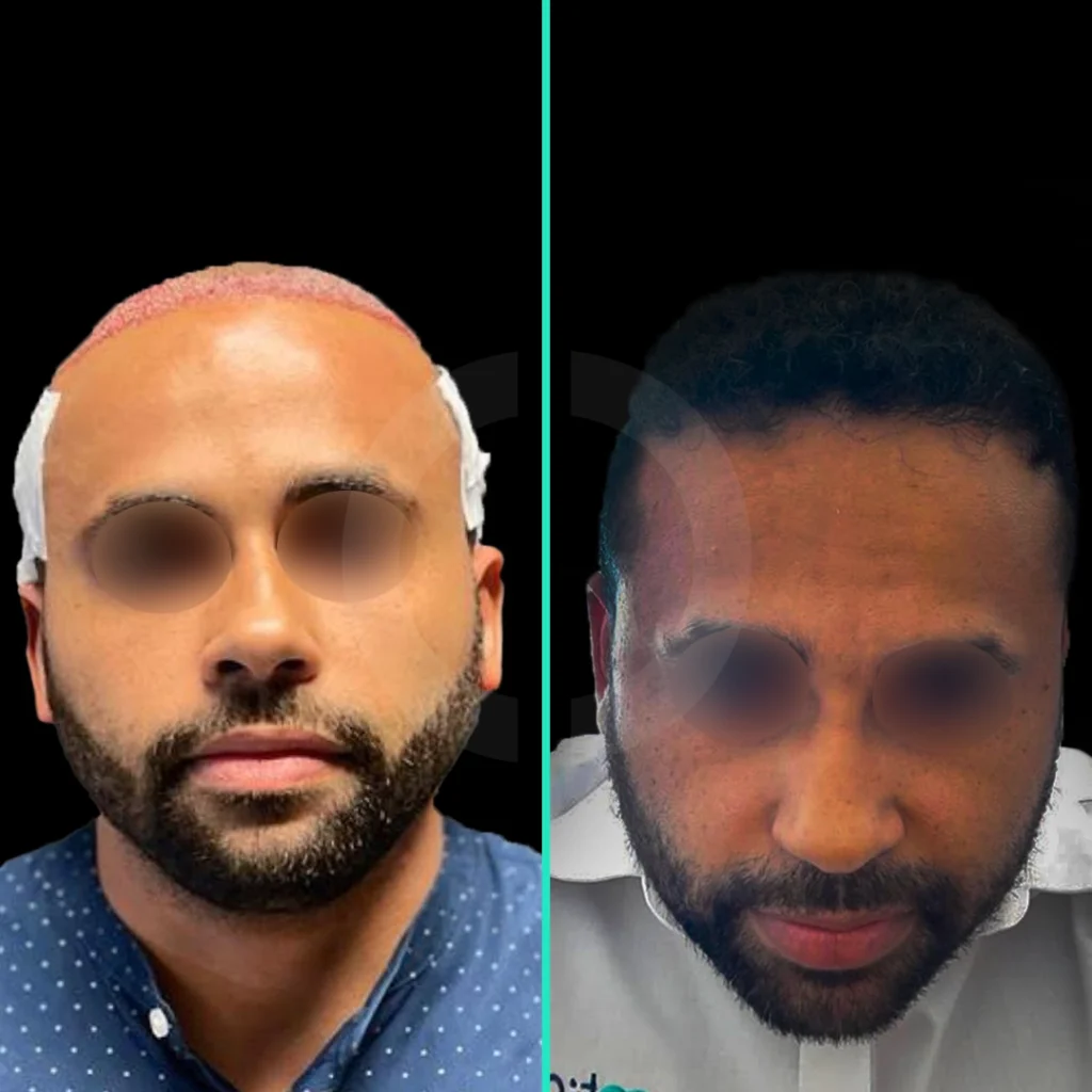 hair-transplant-before-after-2