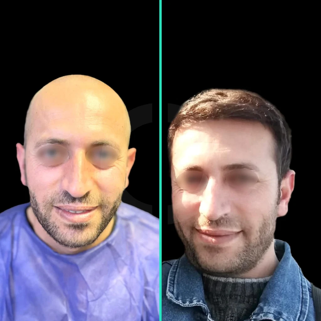 hair-transplant-before-after-3