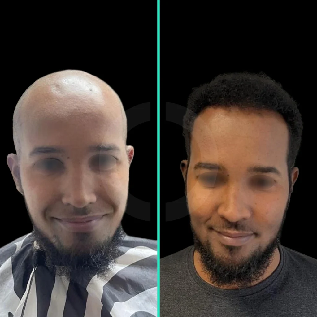 hair-transplant-before-after-4