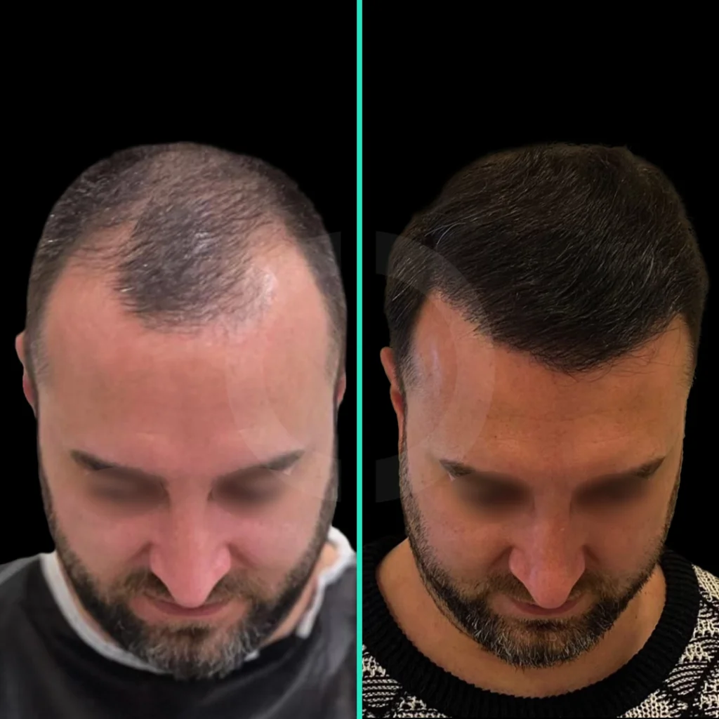 hair-transplant-before-after-5