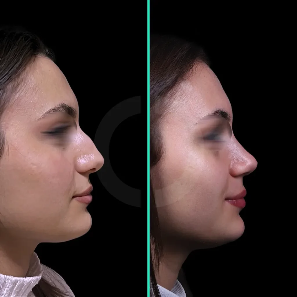 rhinoplasty-before-after-1