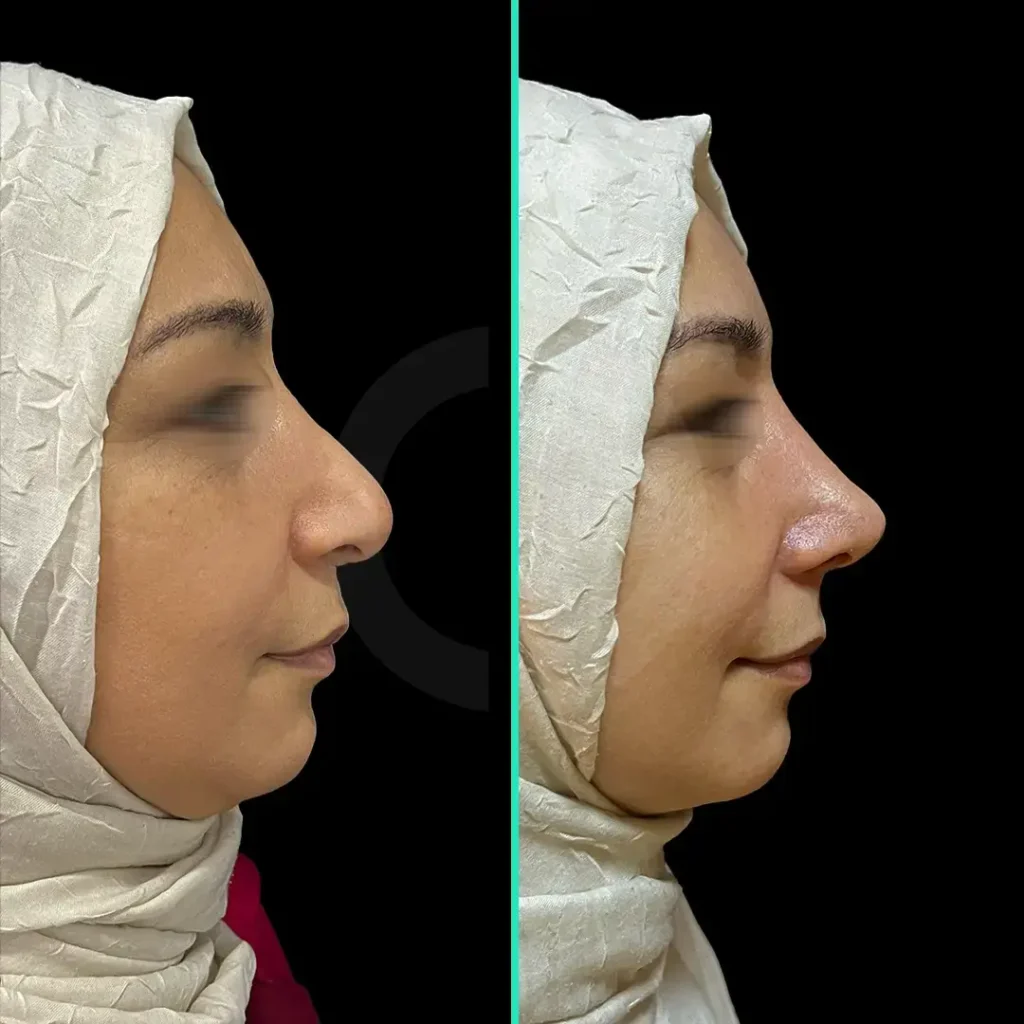 rhinoplasty-before-after-3